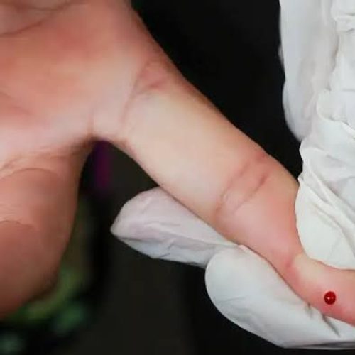 Ministério da Saúde inclui testes rápidos no SUS para ampliar diagnóstico e controle da dengue no Brasil