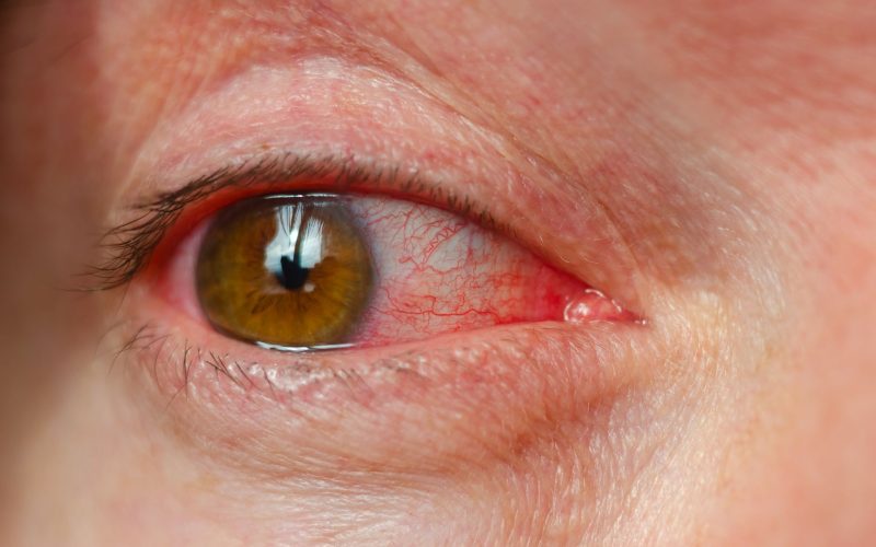 Olhos ardendo e visão embaçada? Tempo seco pode estar por trás do problema