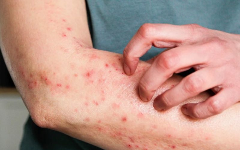 Goiás Investiga Cinco Casos Suspeitos de Mpox em 2026